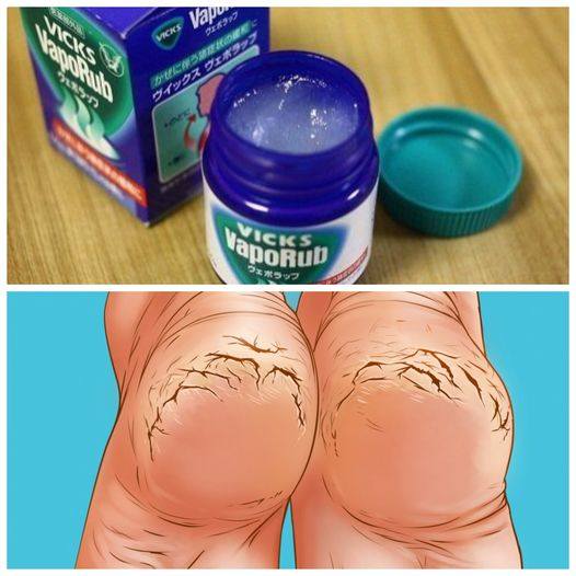 She rubbed her feet with Vicks Vaporub every night. The result will impress you